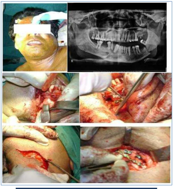 Fig. 17-22: 34 years male patient presented with double fracture mandible  following RTA.ORIF is done by miniplate fixation for paraphyseal fracture; 