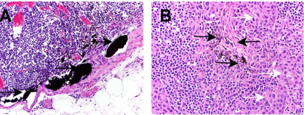 Fig 3. Carbon nanoparticles in SLNs in H-E staining images. A Carbon nanoparticles (as indicated by black arrow) in afferent lymphatic vessel and lymphoid sinus in negative SLNs (x20); B Carbon nanoparticles (as indicated by black arrow) in positive SLNs