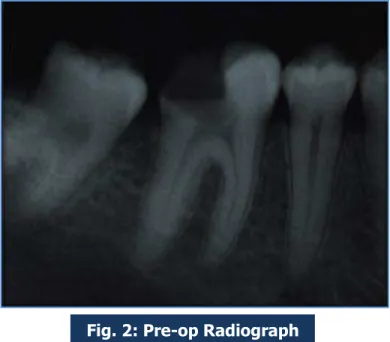 Fig. 2: Pre-op Radiograph 