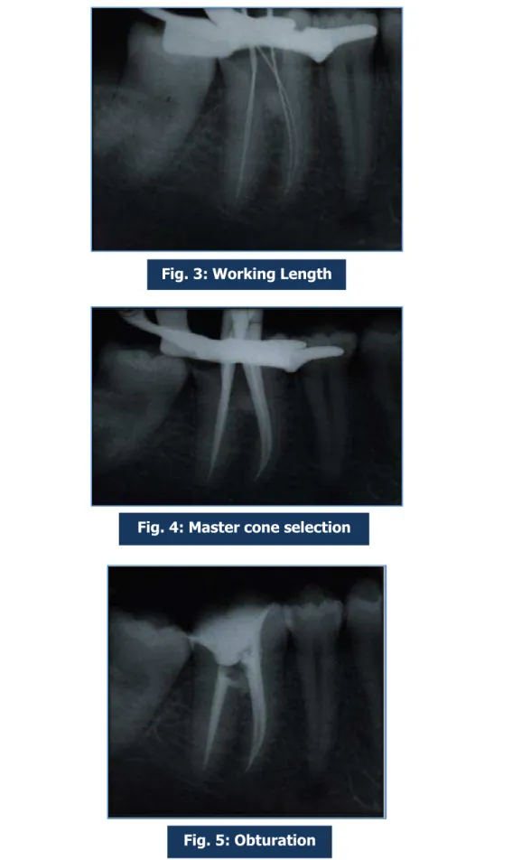 Fig. 4: Master cone selection  CoLengDetermination 