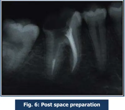 Fig. 7: Final Impression of post space Fig. 6: Post space preparation 