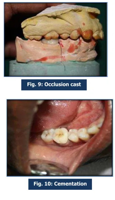 Fig. 9: Occlusion cast 