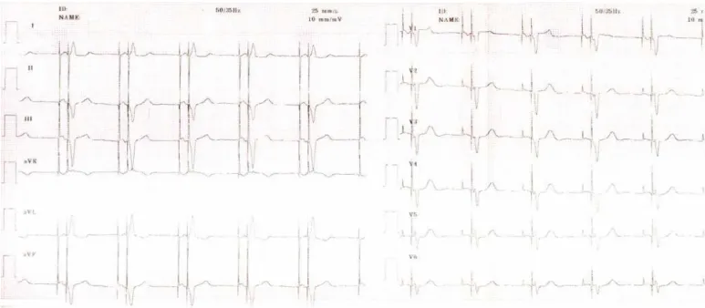 Figure 2. A. I ., 73 y ears old;  EKG -  DDD paced rhy t hm , 60 bpm , QTc= 475m sec. 