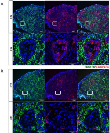 Fig 4. PDGFRβ does not co-localize with tumor cells and endothelium. Double immunofluorescence staining of PDGFRβ/E-Cadherin (A.), and PDGFRβ/VE-Cadherin (B.) on cryosections from oral tumor biopsies