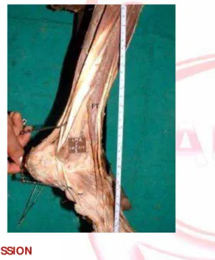 Fig. 1:  Fi bular is Tert ius m uscle and it s t endon.
