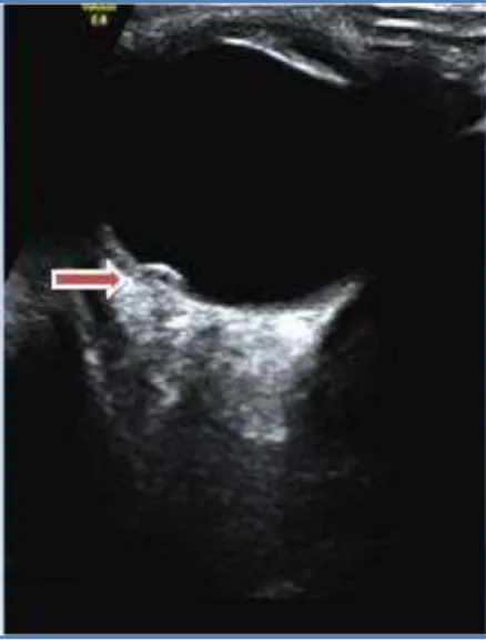 Fig. 17 USG of right eye using high frequency (7-11 Mhz) linear  probe shows a curvilinear echogenic focus in the vitreous chamber  