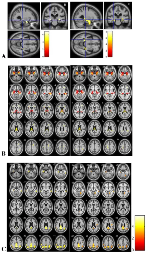 Figure 1. Brain regions of relative atrophy of AD patients with hallucinations compared to healthy controls (A and B left) and AD patients without hallucinations compared to healthy controls (A and B right)