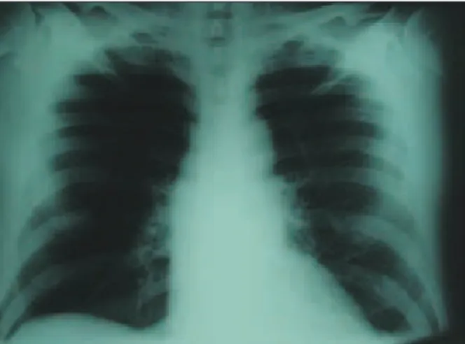 FIGURE 7.  Hemilaminectomy T7.