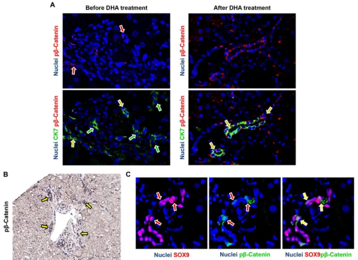Fig 5. Modification of phosphorylated (p) β-catenin expression in ductular reaction and associated hepatic progenitor cells (HPCs) in pediatric NAFLD after docosahexaenoic acid (DHA) treatment