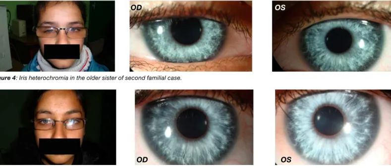 Figure 4: Iris heterochromia in the older sister of second familial case.