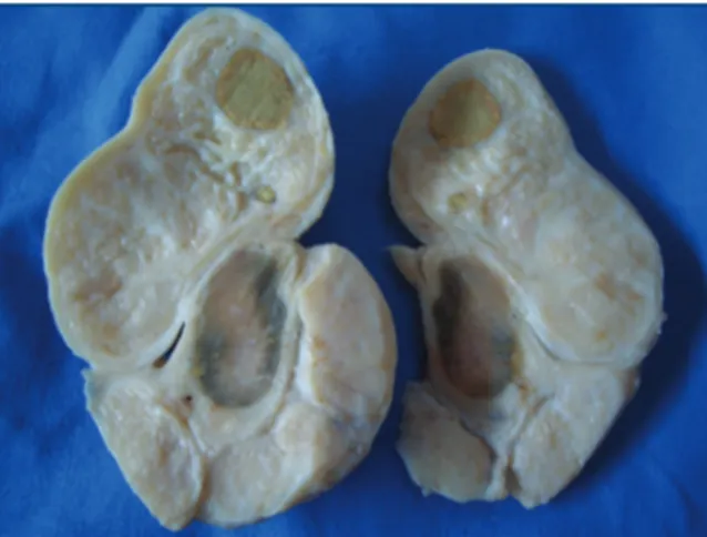 Figure 3. Testes with membranes removed; testicle with normal structure  (above) and an atrophic testicle and enlarged epididymis, with nodular  changes, an altered anatomical structure, displaying ribbon-like growths  (below) of rams from the Pirot Munici