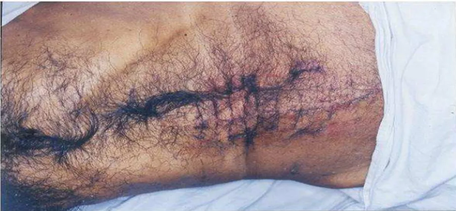 FIG. 2: Clinical photograph of cosmetic scar in pre-operative no hair removal patient 