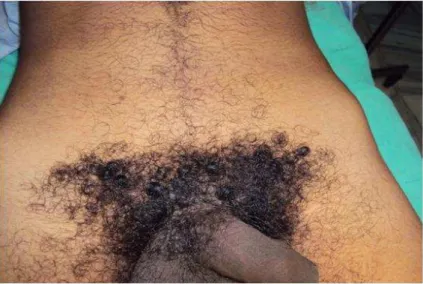 Fig  4.  Clinical  photograph  of  cosmetic  scar  in  pre-operative  no  hair  removal  patient  of  right  sided  inguinal hernia