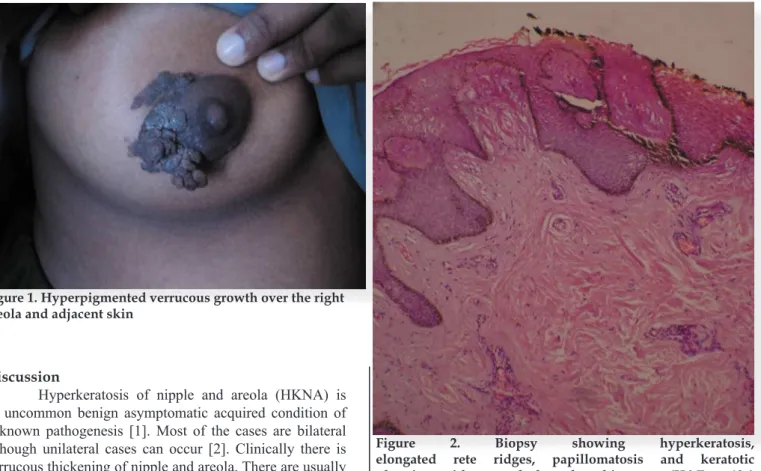 Figure 1. Hyperpigmented verrucous growth over the right  areola and adjacent skin