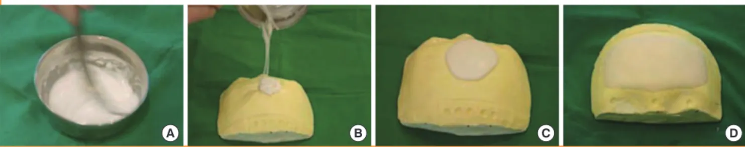 Fig. 1. Dissection area for onlay implant