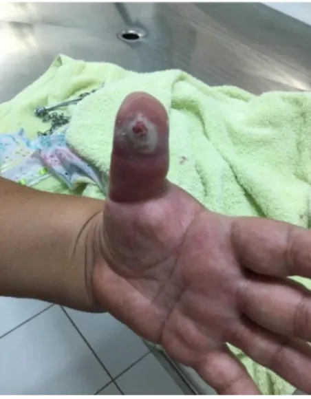 Figura 3. Lesão inflamada e com aspecto de goma observada no dedo polegar da proprietária 