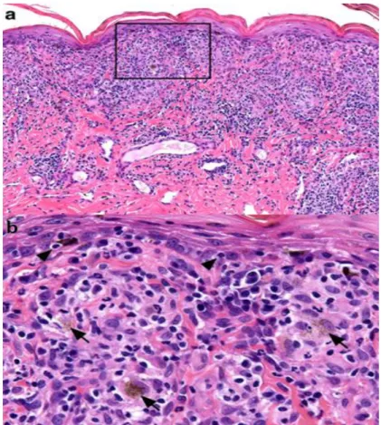 Figure 4. Histopathology of canine uveodermatologic syndrome. Skin biopsy  from the face of a dog