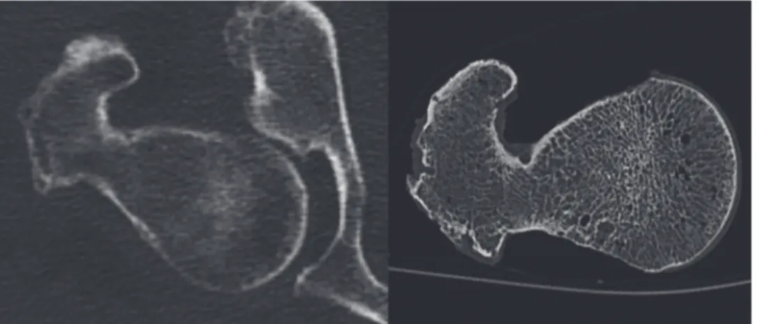 Fig 1. In vivo CT Image of a proximal femur with image noise and artifacts caused by surrounding soft tissue compared to an in vitro CT Image with better depiction of the trabecular and cortical structures.