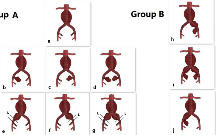 Fig 1. * Indications for group A (a, b, c, d, e, f, g): a: Standard abdominal aortic aneurysm (AAA; not coupled with common iliac artery aneurysm, CIAA), but the landing zone in the common iliac artery (CIA) was too short to anchor