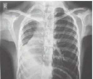 Figure 3.   Absence  of  right  lung  parenchyma  and  right  main  bronchus with hypertrophy of left lung on chest CT 