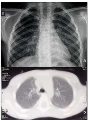 Fig. 1 – a) Chest radiography revealing fine reticulonodular pattern of lung interstitium involvement;