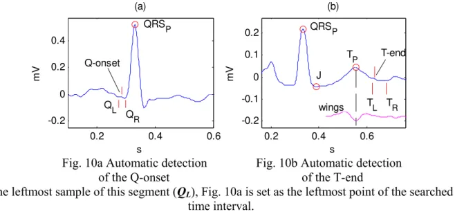 Fig. 10a Automatic detection  of the Q-onset 
