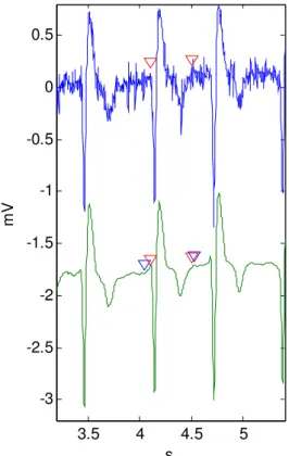 Fig. 3 Example of the electromyographic  noise influence on the QT measurement  Mains interference 