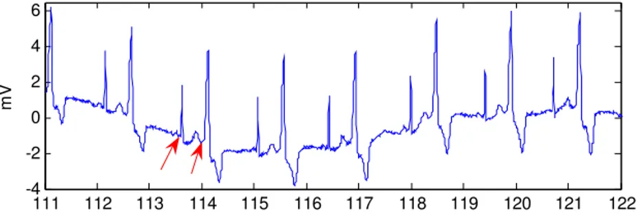 Fig. 5 The baseline drift noise is usually not influencing the correct QT measurements  Low magnitude of the T wave 