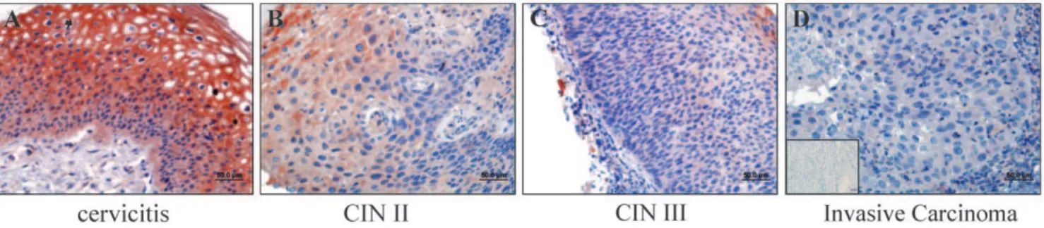 Table 1. RECK expression in cervicitis, CIN I, CIN II/III and invasive cervical carcinomas.