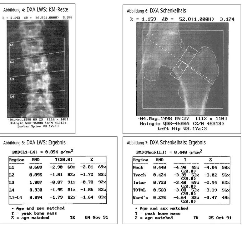 Abbildung 7:  DXA Schenkelhals: Ergebnis