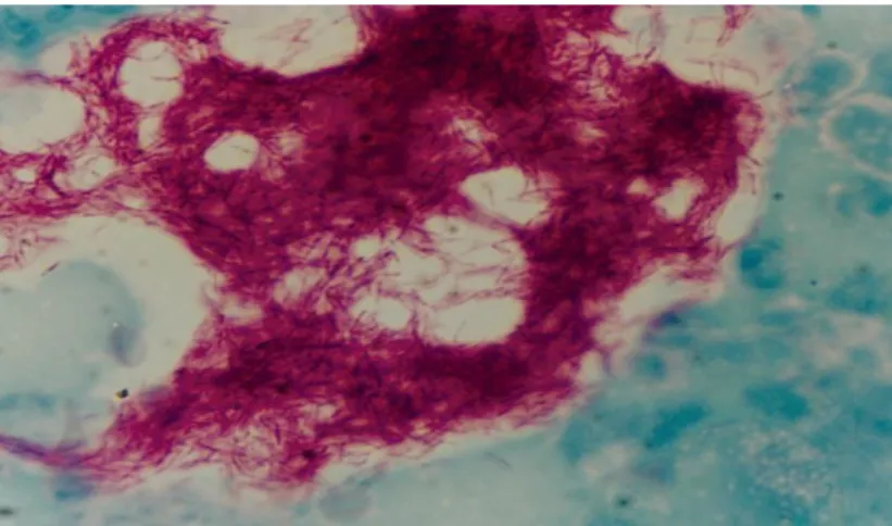 Figura 2. Bastonetes álcool-ácido resistentes observados ao exame citológico (Ziehl- (Ziehl-Neelsen, 40x)