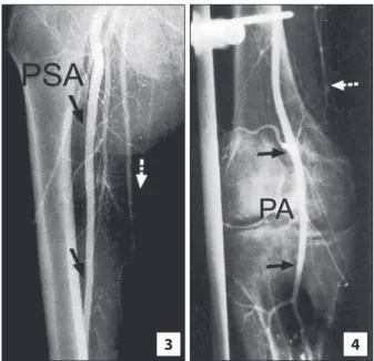 FIGURE 4.  Right femoral angiography, distal portion: sciatic artery is in  continuity with the popliteal artery (PA, black arrows), while the  femo-ral artery terminates above the knee (white arrow).