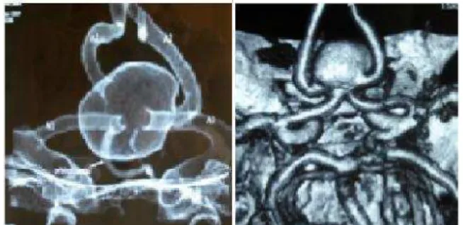 Figure 2. 3D-CT scan reveals that A2 segments are watched to  originate from posterolateral aneurysm