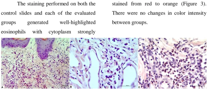 Figure 3 – Skin – Eosinophils in inflammatory infiltrate evidenced by Pagoda Red staining