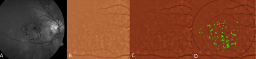 Fig 2. Illustration of drusen segmentation methods. A) Red-free fundus photo. Areas with drusen are circled in black (human supervision) to initialize the segmentation program