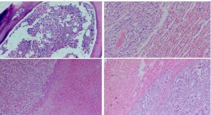 Figure 2. Histopathological appearance of cutaneous melanoma metastases in horse. A: bone marrow  exhibiting neoplastic  infiltration (at the center)  of permeation with the  hematopoietic cells (staining: 