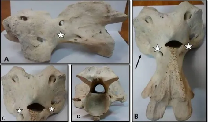 Figure 1. Complete bilateral fusion of the atlas and axis. A – The left lateral view of complete atlanto-axial  malformation (CAAM)