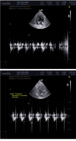 Figura  2.  Ecodopllercardiograma.  (A)  Imagem  das  quatro  câmaras  cardíacas  evidenciando  aumento  atrial  esquerdo  e  direito,  aumento  de  espessura  da  parede  livre  de  ventrículo  esquerdo  e  válvula  mitral  espessada