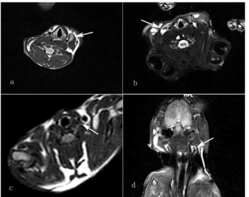 Figure 2. T2-weighted image of the neck shows a metastatic lymph node with partial high signal intensity, significantly higher than that of muscle tissue