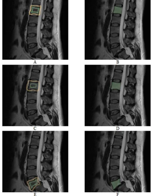 Figure 15. Vertebrae segmentation with the GrowCut approach. The images on the left side (A, C and E) show examples for a manual initialization of the algorithm: vertebra (green) and background (yellow)