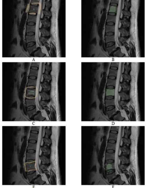 Figure 16. As for Figure 15, vertebrae segmentation with the GrowCut approach. The images on the left side (A, C and E) show examples for a manual initialization of the algorithm: vertebra (green) and background (yellow)
