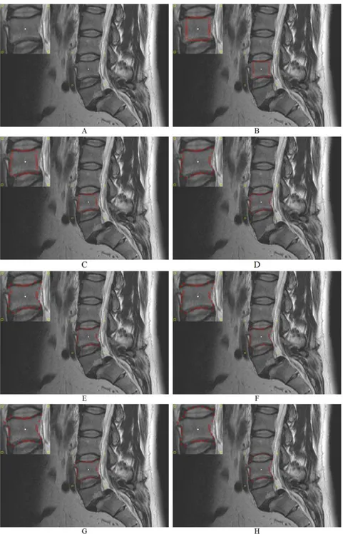 Figure 8 shows on the left side a sagittal view of a MRI spine dataset. On the right side of the Figure 8 an user-defined seed point (white) has been set inside a vertebra
