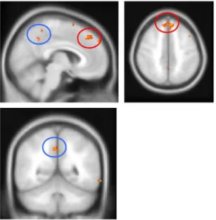 Figure 4. Voxel-based morphometry analysis with the apraxia score as a covariate in CBS patients