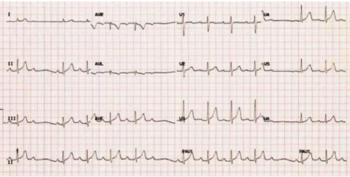Figure 1. ECG at the time of admission to the hospital