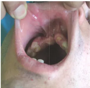 Fig 1: Photograph showing the m anterior alveolar ridge defect.