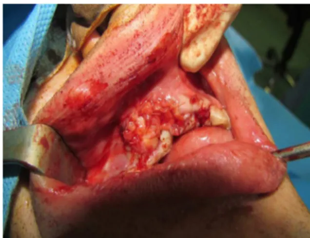 Fig 6: Photograph of the bilateral palatal  submucosal periosteal connective tissue flap 