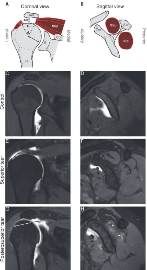Fig 2. Schematic illustration of the measurements and representative MRA scans of coronal (A, C, E, G) and sagittal (B, D, F, H) of the shoulder in the patient groups