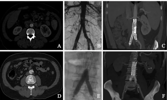 Fig. 1. Preoperative CTA showing ‘‘double-barreled’’ appearance of the abdominal aorta (a)