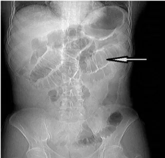Figure  1:  CT  topogram  reveals  dilated  small  bowel loops (arrow)