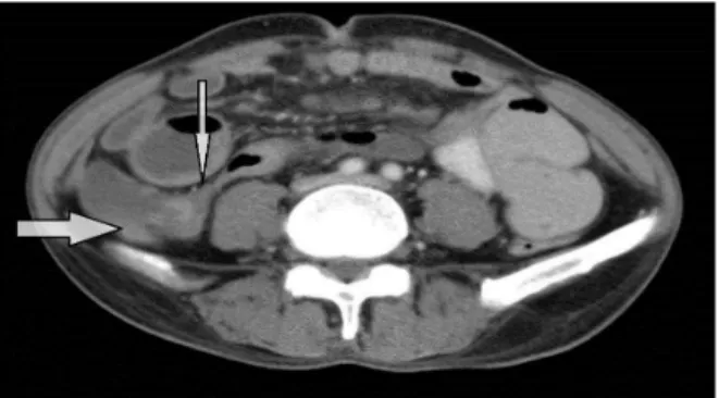 Figure 2A: NCCT abdomen showing mild thickening of wall of hepatic flexure (arrow)